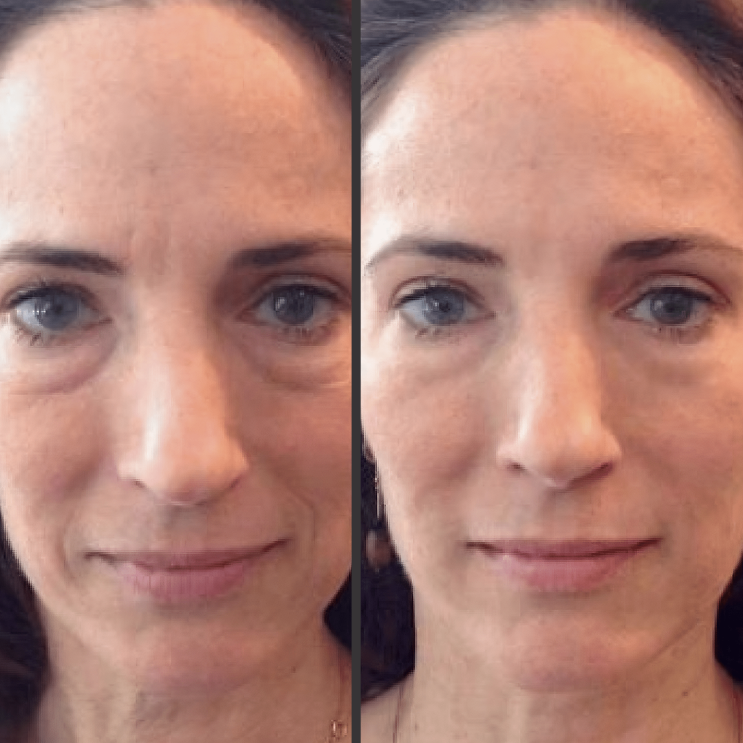 Woman facial changes due to ems gua sha therapy