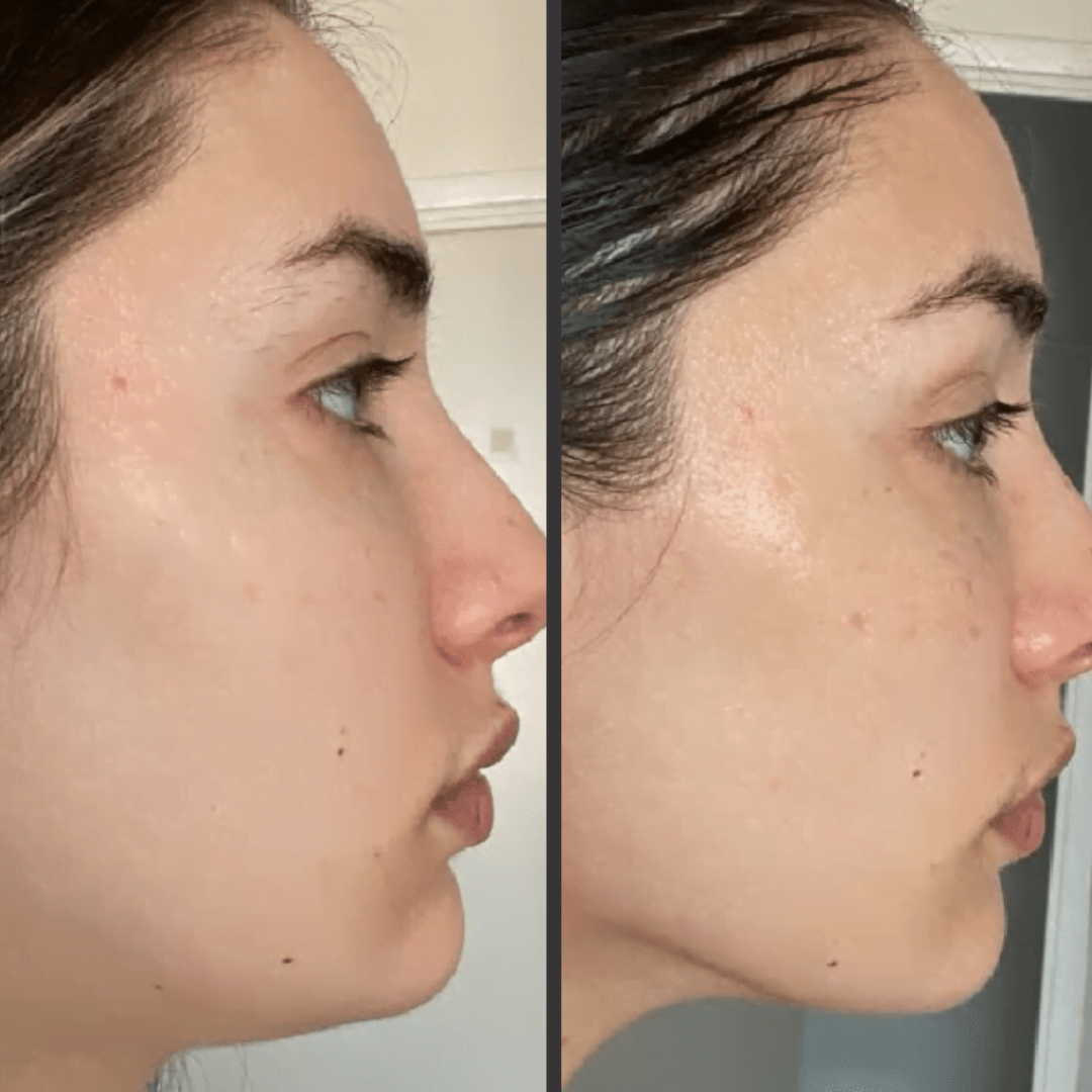 womans facial side profile change after gua sha therapy